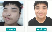 Ngủ dậy, nam sinh tá hỏa vì trúng khẩu nhãn oa tà