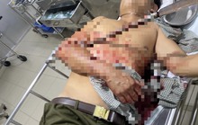Ngăn chặn hỗn chiến, tổ trưởng dân phòng bị đâm xuyên cánh tay