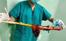 Ớn lạnh người đàn ông bị cây gỗ đâm xuyên từ trước ngực ra sau lưng