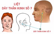 Làm sao chữa di chứng liệt dây thần kinh số 7 sau khi bị zona?