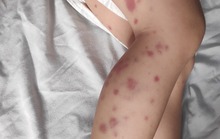 Bé trai lộ bệnh như bị bạo hành khiến cha mẹ một phen sợ hãi