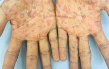 Dấu hiệu nhận biết giang mai ác tính