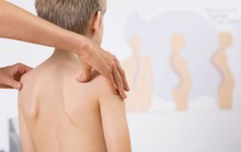 Làm gì khi trẻ bị gù lưng, cong vẹo cột sống?