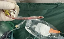 Bác sĩ cấp cứu đau lòng trước bé gái 3 tuổi sặc thức ăn ở nhà trẻ