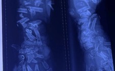 Tai nạn lao động thương tâm: Công nhân 37 tuổi bị máy nghiền vỏ dừa cán nát cánh tay