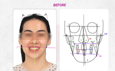 Cân chỉnh đường giữa và chữa lệch mặt bằng phương pháp niềng răng
