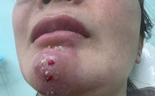 Tin quảng cáo “bật tông nhanh”, nhiều người biến dạng mặt vì làm đẹp cận Tết