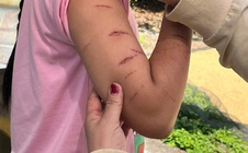 Sở Y tế tỉnh Cà Mau thông tin về vụ nữ sinh bị chị họ gây thương tích