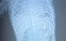 Dị vật sắc nhọn nằm trong dạ dày bệnh nhi 21 tháng tuổi