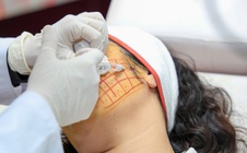 Căng chỉ làm đẹp, cô gái phải lấy dị vật dưới da