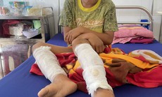 Một cháu bé 9 tuổi ở Quảng Bình bị người thân dùng xăng và rơm đốt