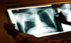Mỹ: Từ chối điều trị lao phổi, tòa ban trát cưỡng chế