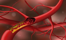Cholesterol cao: Thêm nguyên nhân bất ngờ, không liên quan ăn uống