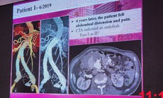 Cảnh giác với bệnh lý mạch máu