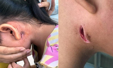 Nhiều người nhiễm vi khuẩn "ăn thịt người", Bộ Y tế ra khuyến cáo