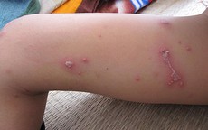 Nằm bệnh viện, bệnh nhân bị kiến ba khoang tấn công