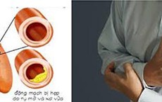 Phòng ngừa cơn đau thắt ngực