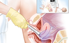 Dấu hiệu phát hiện sớm ung thư âm đạo