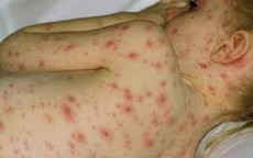 Bị trái rạ, uống nước gốc rạ có khỏi bệnh?