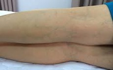 Suy tĩnh mạch: Phòng hơn chữa