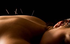Châm cứu giúp giảm đau bụng kinh