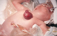 Bé sơ sinh mắc dị tật cực hiếm: Tim ngoài lồng ngực!