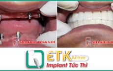 Cấy ghép răng Implant ETK Active ở đâu?