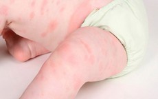 Không hẳn trẻ ngứa là dị ứng!