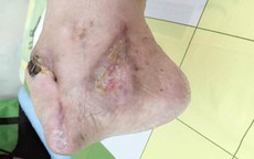 Giẫm gai, mất luôn nửa bàn chân