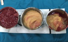 Rút cả lít hóa chất lạ trong ngực nữ Việt kiều