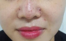 Tiêm filler nâng mũi, một phụ nữ bị biến chứng