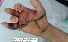 Xuyên đêm nối lại bàn tay bị máy cưa cắt đứt lìa
