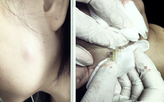 Tiêm botox làm đẹp, người phụ nữ 30 tuổi phải nhập viện