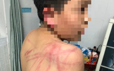 Khởi tố, bắt giam kẻ bạo hành con ruột dã man ở Đà Lạt
