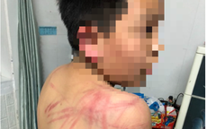Lãnh đạo TP Đà Lạt thăm hỏi cháu trai 10 tuổi bị cha bạo hành dã man
