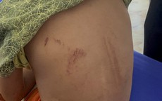 Một cháu bé 9 tuổi ở Quảng Bình bị người thân dùng xăng và rơm đốt