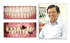 Giải pháp tối ưu trong điều trị mất răng toàn hàm từ nghiên cứu của TS Trần Hùng Lâm