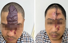Tái tạo khuôn mặt cho thanh niên bị khối dị dạng mạch máu khổng lồ