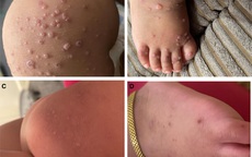 PCR và giải mã gien chỉ ra danh tính "cúm cà chua" bí ẩn ở trẻ