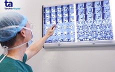 2 đường mổ cùng lúc lấy u lạ nhiều "râu" trong đầu
