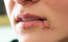 Quan hệ bằng miệng có mắc bệnh lây qua đường tình dục?