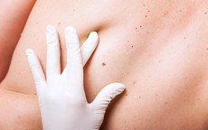LƯU Ý: 5 bước tự phát hiện ung thư da