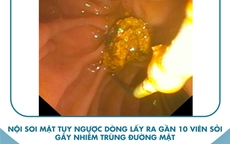 Nguy kịch vì bụng chứa hàng chục viên sỏi