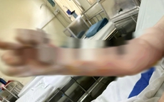 Hai người đàn ông bị bỏng nặng khi đốt rác