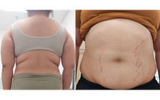 Bé gái 14 tuổi tăng 20kg, thấp đi 6cm vì căn bệnh siêu hiếm