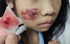 Khỉ hoang tấn công, bé gái 7 tuổi nhập viện