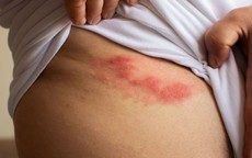 Đáng sợ cơn đau dai dẳng sau khỏi bệnh “giời leo”