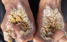 Người đàn ông thứ hai tại Việt Nam mắc hội chứng “người cây”