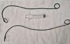 Bệnh nhân ở Cà Mau "bỏ quên" ống thông JJ trong người suốt hơn 10 năm