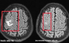 Co giật do sán não suýt nhầm lẫn với u não